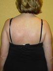 Nov. 2005 Scoliosis Progression